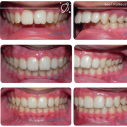 What cavity classifications use a posterior matrix system