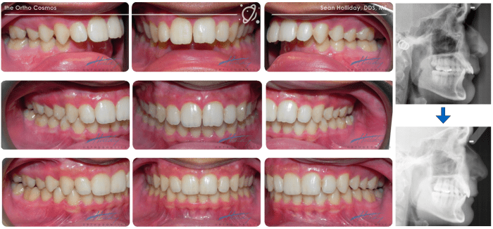 What cavity classifications use a posterior matrix system