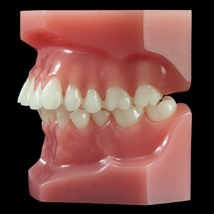 What cavity classifications use a posterior matrix system